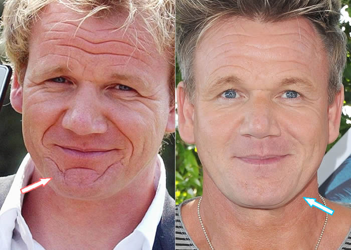 gordon ramsay before and after face surgery
