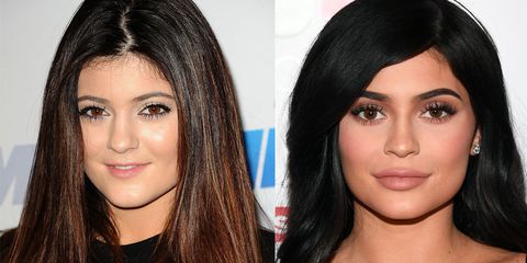 Kylie Jenner Lips Before And After