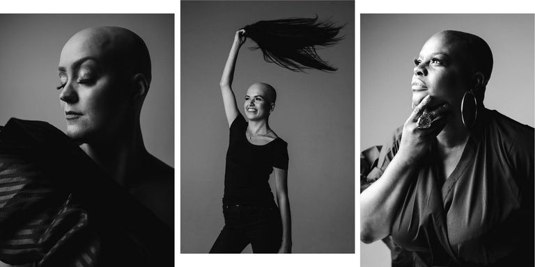 Alopecia photoshoot