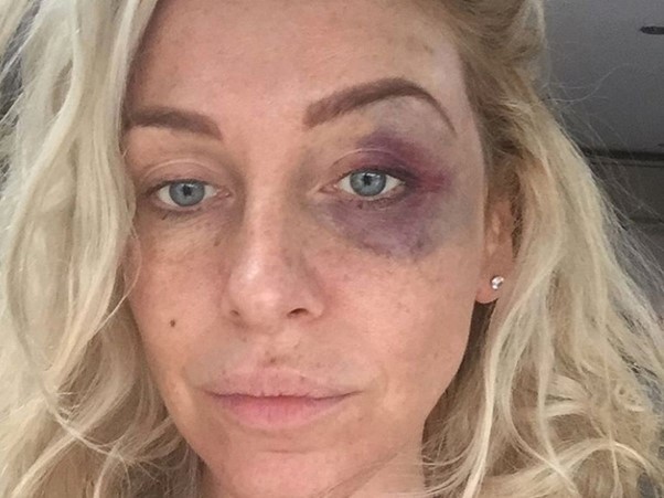 Josie Gibson reveals her black eye after a terrifying assault.