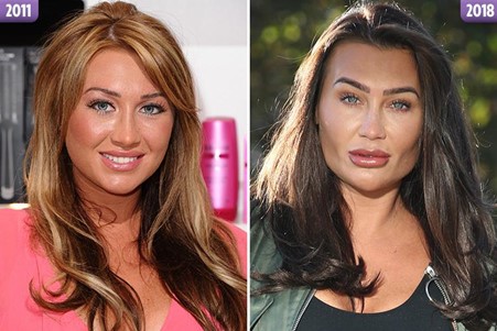 Lauren Goodger before and after surgery.