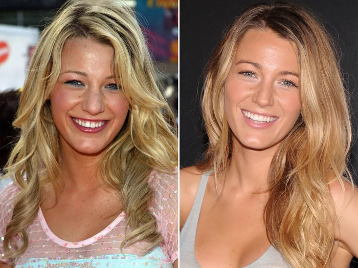 Blake Lively Nose Job