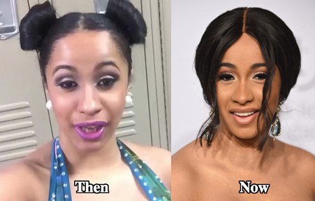 Cardi B teeth, before and after.