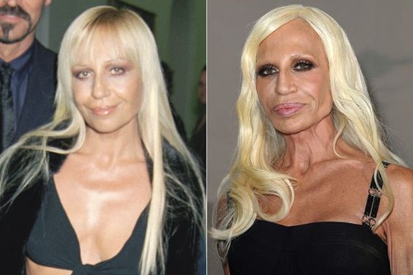 Donatella Versace Plastic Surgery: Her dramatic use of surgical enhancements.